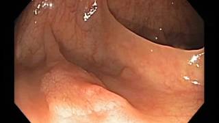 Colonoscopy Channel  Serrated adenoma with intramucosal cancer [upl. by Tedra16]