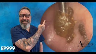 Removing a chunky ear wax plug from an ear  EP999 [upl. by Ikey162]