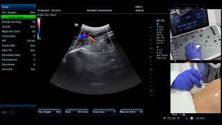 ¿Cómo realizar la medición de la Arteria Uterina con Ecografía Doppler [upl. by Lorak]