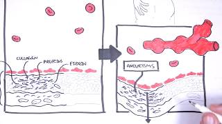 Polyarteritis Nodosa and Kawasaki Disease Medium Vessel Vasculitis  Symptoms pathophysiology [upl. by Harmaning]