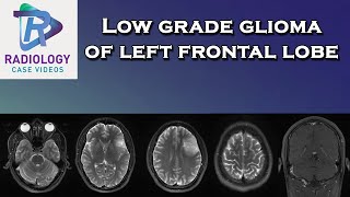 Low grade glioma of left frontal lobe [upl. by Odab]