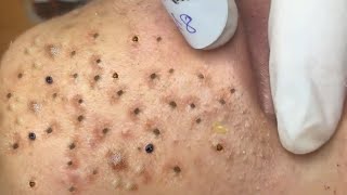 Big Cystic Acne Blackheads Extraction Blackheads amp Milia Whiteheads Removal Pimple Popping  8436 [upl. by Neellek577]