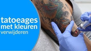 GEKLEURDE TATOEAGES verwijderen  Hoe kom ik van mijn gekleurde tattoo af [upl. by Aneger]