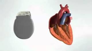 Implantation dun Pacemaker [upl. by Eaves47]