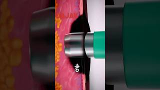 How Skin Biopsies Are Done and why they’re important [upl. by Clevey]