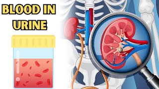 Understanding the Causes of Blood in Urine Hematuria for Better Health What Causes Hematuria [upl. by Godden]