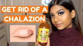 HOW TO GET RID OF A CHALAZION FAST AT HOME [upl. by Gerti422]