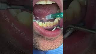 Igiene dentale professionale tramite strunento ad ultrasuo [upl. by Hudson770]