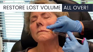 NonSurgical Liquid Facelift with Filler [upl. by Lilla]