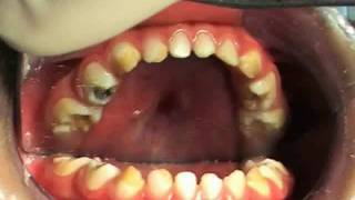 Amelogenesis amp Dentinogenessis Imperfecta Pediatric Dentistry General Anesthesia [upl. by Hyams]