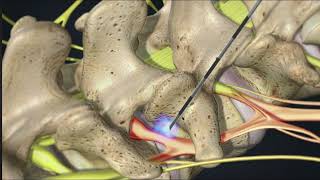 Transforaminal Root block injection [upl. by Hugues]