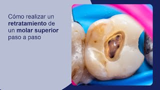 Cómo realizar un retratamiento de un molar superior paso a paso [upl. by Eilra408]