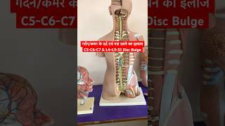 Cervical Problem amp Lower Back Pain Treatment shorts sciatica neckpain [upl. by Ekram]