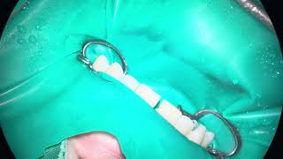 1121 diastema resin filling under rubber dam bioclear [upl. by Selena]