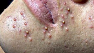 Big Cystic Acne Blackheads Extraction Blackheads amp Milia Whiteheads Removal Pimple Popping  9245 [upl. by Nwahsit]