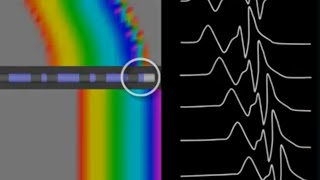 Ablation target for WPW Differential Pacing Maneuvers SVT EPS in Cardiac Electrophysiology [upl. by Kilk890]