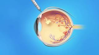 US Ophthalmic Retina Macular Edema Injection [upl. by Emilee]