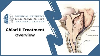 Chiari II Treatment Overview [upl. by Yartnod77]