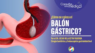 ¿Cómo se coloca un balón gástrico [upl. by Ulyram773]