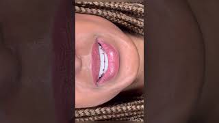 Porcelain Veneers in Dubai  Dr Nazima Yakubova dentist veneers cosmeticdentistry [upl. by Yadrahs200]