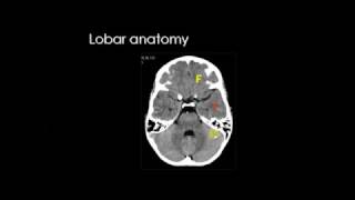 MRICT brain for lobar anatomy [upl. by Ailegra]