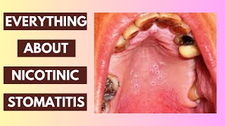 Nicotinic Stomatitis Explained Causes Symptoms and Treatment Options  InDepth Lecture [upl. by Trumann]