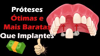 Prótese Fixa e Adesiva  Ótimas Opções Para Substituir Dentes Perdidos Além do Implante Dentario [upl. by Lebama]