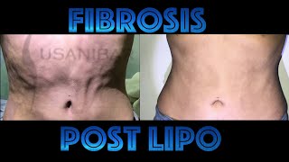 Fibrosis Post Lipo [upl. by Anilrahc]