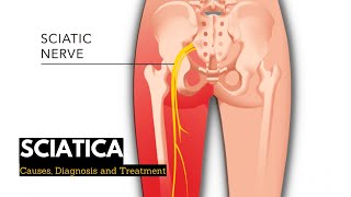 Sciatica Causes Signs and Symptoms Diagnosis and Treatment [upl. by Samot]