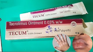 Tecum 003 ointment review। Tacrolimus ointment 003 ww। Leucoderma। Vitiligo। सफ़ेद दाग [upl. by Nilesoj]