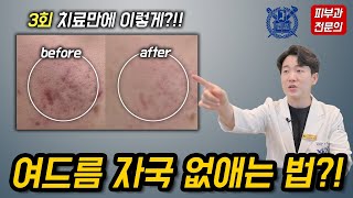 여드름 자국 없애는 법 알려드립니다 빠르게 여드름 치료 가능합니다 여드름여드름흉터여드름자국여드름 [upl. by Studley640]