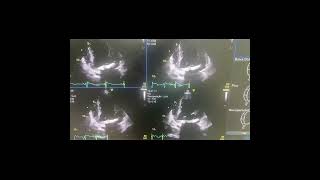 Pulmonary hypertension stress echo [upl. by Grekin]