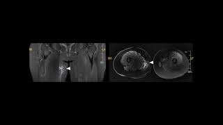 Technique of Distal Tendon Excision for the Treatment of Chronic Pain Caused by Isolated Proximal Gr [upl. by Chapell]