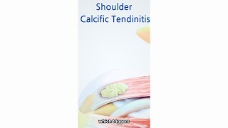 Unveiling The Stages Of Calcific Tendinitis Symptoms [upl. by Denman]