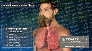 MESOTHELIOMA AND ASBESTOS DIGESTION [upl. by Berriman]