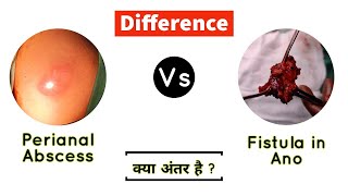 PERIANAL ABSCESS vs FISTULA IN ANO  Difference [upl. by Otreblif584]