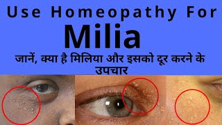 Milia Homeopathic Medicine For Milia [upl. by Maurizio]