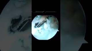 Arthroscopic Popliteal cyst  Bakers Cyst valves opening with AL and PM portal only [upl. by Ardnuahc]