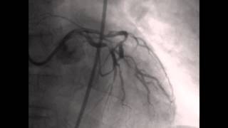 Coronary angiography CAG [upl. by Nosrak]