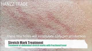 CO2 Fractional Laser Stretch Marks Treatment [upl. by Nnyleve903]