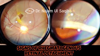 Clinical Signs Of Rhegmatogenous Retinal Detachment [upl. by Cynthia]