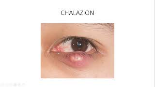 OBENG SERIES  CHALAZION AND HORDEOLUM [upl. by Aicilaanna]