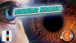 Nummular keratitis  Your EYEBALLS  EYNTK 👁️👁️💉😳💊🔊💯✅ [upl. by Anneg]