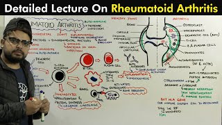 Rheumatoid Arthritis Pathophysiology of Arthritis [upl. by Bram]