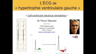 7a L’ECG de lhypertrophie ventriculaire gauche HVG Basic Dr Taboulet [upl. by Eladnyl]