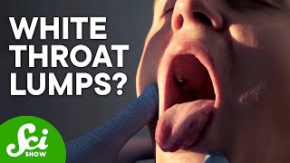 What Are Tonsil Stones amp How Do I Get Rid of Them [upl. by Marline]