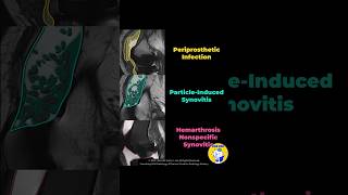 Fig 5D19 PostTKA Synovitis Infection ParticleInduced and Nonspecific [upl. by Lamahj]