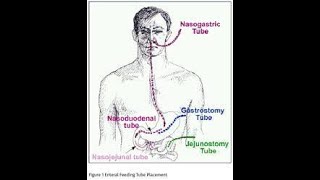 Jejunostomy Feeding Tube [upl. by Darice448]