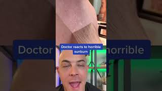 So Painful Doctor reacts to sunburn peeling [upl. by Mandle]