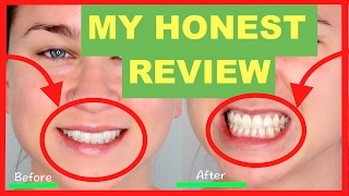 Charcoal teeth whitening powder review ♥♥2017♥♥ Before and After [upl. by Atir]